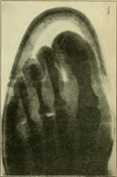 Same shoe from above, showing pointed toe box too narrow for the toes, and hallux valgus deformity. The high heel shifts weight forwards, putting additional pressure on the sides of the toes