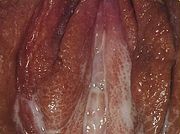 Vaginaler Ausfluss bei Gonorrhoe.