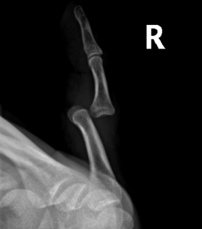 Radiograph of right fifth phalanx dislocation resulting from bicycle accident