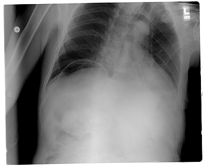 Another pneumoperitoneum on chest X-ray.