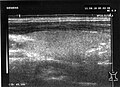 rechter Schilddrüsenlappen im Längsschnitt - Drahreg01