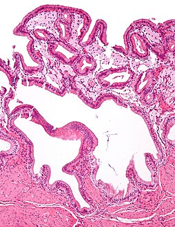 Micrograph of cholesterolosis of the gallbladder