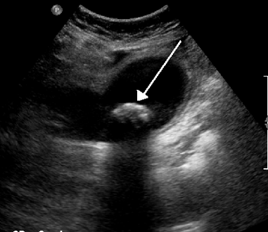 A 1.9 cm gallstone impacted in the neck of the gallbladder and leading to cholecystitis as seen on ultrasound. There is 4 mm gall bladder wall thickening.