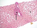 Histopathology of steatohepatitis with mild fibrosis in the form of fibrous expansion (Van Gieson's stain)[84]