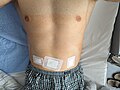 Operationswunden Leistenoperation minimalinvasiv (mit Wundpflaster)