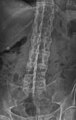 X-ray showing bamboo spine in a person with ankylosing spondylitis