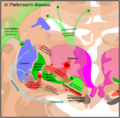 Basal ganglia in Parkinson's disease. Attribution-Share Alike 3.0 Unported licensing, attributed to Patrick J. Lynch, Andrew Gillies and Mikael Häggström