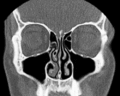 Nasenscheidewand in einer frontalen CT-Aufnahme, mittig zeigt sich die Scheidewand, jeweils davon lateral u. a. die Conchae nasales (die rechten – links im Bild – sind angeschwollen), Meatus nasi