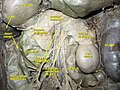 Dissection showing the anatomical relationship between the superior mesenteric artery and surrounding structures