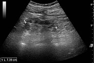 Chronic pyelonephritis with reduced kidney size and focal cortical thinning. Measurement of kidney length on the US image is illustrated by ‘+’ and a dashed line.[20]