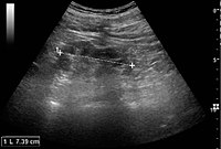 Chronic pyelonephritis with reduced kidney size and focal cortical thinning. Measurement of kidney length on the US image is illustrated by '+' and a dashed line.[55]
