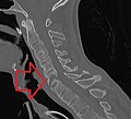 CT scan showing bamboo spine in ankylosing spondylitis