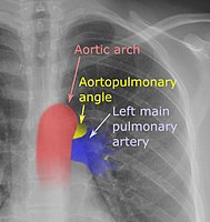 Aortopulmonary angle