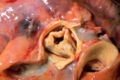 Aorta and coronary arteries at autopsy. The proximal portion of the RCA and its ostium can be seen at the lower left.
