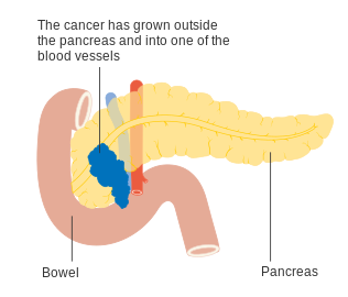 Stage T4 pancreatic cancer