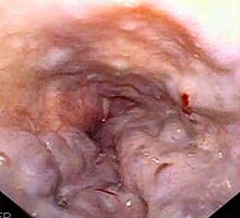 Purple longitudinal tubular structures with red spots in the esophagus at the time of endoscopy