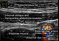 Abdominal ultrasound showing a normal appendix between the external iliac artery and the abdominal wall