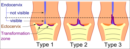Transformation zone types:[19] Type 1: Completely ectocervical (common under hormonal influence). Type 2: Endocervical component but fully visible (common before puberty). Type 3: Endocervical component, not fully visible (common after menopause).