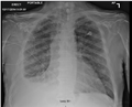Fibrothorax and pleural effusion caused by silicosis