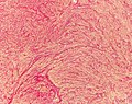 Histopathology of uterine leiomyoma. Variant of Van Gieson's stain
