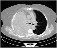 CT scan of the chest showing a hemothorax caused by warfarin use