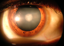A visibly opacified central part of the lens of an eye with widely dilated iris