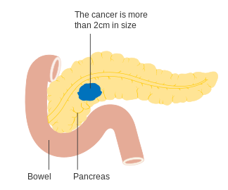 Stage T2 pancreatic cancer