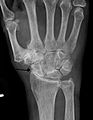 Severe osteoarthritis and osteopenia of the carpal joint and 1st carpometacarpal joint