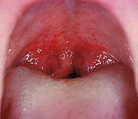Mouth wide open showing the throat Note the petechiae, or small red spots, on the soft palate. This is an uncommon but highly specific finding in streptococcal pharyngitis.[14]