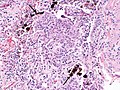 The black arrows point to ferrugionous bodies that are located at the periphery of a focus of non-small cell lung carcinoma, NOS.