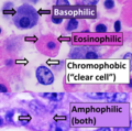 Eosinophilic staining, using eosin Y, compared to other patterns when using hematoxylin and eosin (H&E).