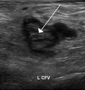 An ultrasound with a blood clot visible in the left common femoral vein. (The common femoral vein is distal to the external iliac vein.)