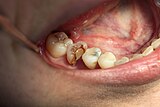 Intraorale Aufnahme der Situation 16 Jahre nach Hemisektion, die 16 jahre alte Kunststofffüllung ist stark abradiert und insuffizient, weshalb der Zahn nunmehr überkront wurde.