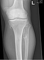 multiple osteochondromas around the knee