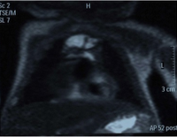 Chest MRI showing a hemothorax in a 16-day-old infant