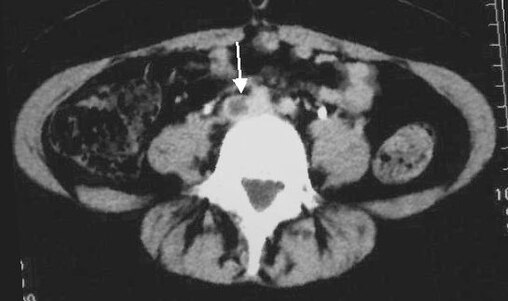 An abdominal CT scan demonstrating an iliofemoral DVT, with the clot in the right common iliac vein of the pelvis