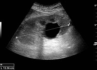 Figure 5. Simple renal cyst with posterior enhancement in an adult kidney. Measurement of kidney length on the US image is illustrated by '+' and a dashed line.[1]