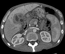 CT scan showing cholangiocarcinoma.