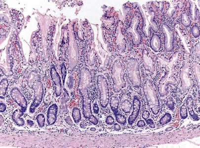 Histopathology of antral mucosa with atrophy. H&E 10x. Antral gastric mucosa with accentuated atrophy because replacement by extensive intestinal metaplasia.
