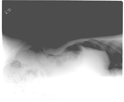 Pneumoperitoneum seen on X-ray with the patient lying on his left side.