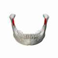 Position of coronoid process in mandible (shown in red)