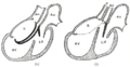 Diagrams to illustrate the transformation of the bulbus cordis. Ao. Truncus arteriosus. Au. Atrium. B. Bulbus cordis. RV. Right ventricle. LV. Left ventricle. P. Pulmonary artery.