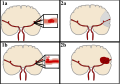 There are two categories of strokes. One is an ischemic stroke, caused by a blood clot in a vein or artery of the brain. The other is a hemorrhagic stroke, caused by a ruptured artery or vein leading to blood leaking into the brain cavity. 1a.Diagram of a brain showing a blood clot in the middle cerebral artery blocking the flow of oxygen-rich blood to a portion of the brain thus cutting off access to oxygen and nutrients. 1b.The brain death, represented by the grey area, as a result of the lack of blood due to the blood clot. 2a.Diagram of a brain showing a rupture in the middle cerebral artery causing blood to leak out of the artery. 2b.The blood leakage into the brain, represented by the red area, as a result of a ruptured artery.
