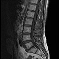 MRI lumbar spine with degeneration (sagittal T1 FSE)