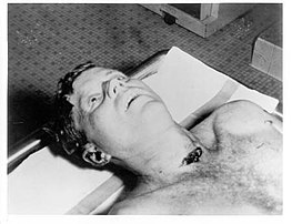 A picture of President Kennedy's head and shoulders taken at the autopsy