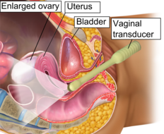 Transvaginal ultrasonography - schematic. Attribution-Share Alike 3.0 Unported licensing, attributed to BruceBlaus and Mikael Häggström