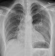 Anteroposterior expired X-ray at the same time, more clearly showing the pneumothorax in this case