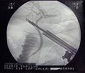 X-ray guided cholecystectomy