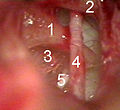 Stapedotomie mit Laser (1 = langer Ambossschenkel, 2 = Hammergriff, 3 = Steigbügelfußplatte mit Kreis des Pilotlasers, 4 = Chorda Tympani (Geschmacksnerv), 5 = Sehne des Steigbügel- muskels)