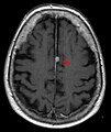 T1 (note CSF is dark) with contrast (arrow pointing to meningioma of the falx)